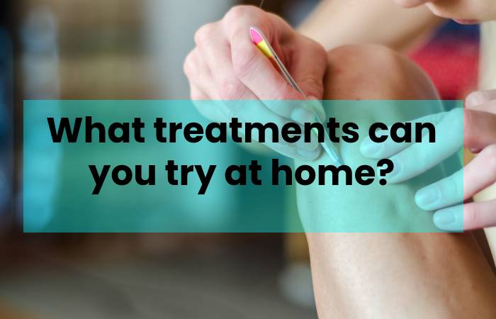 What treatments can you try at home?