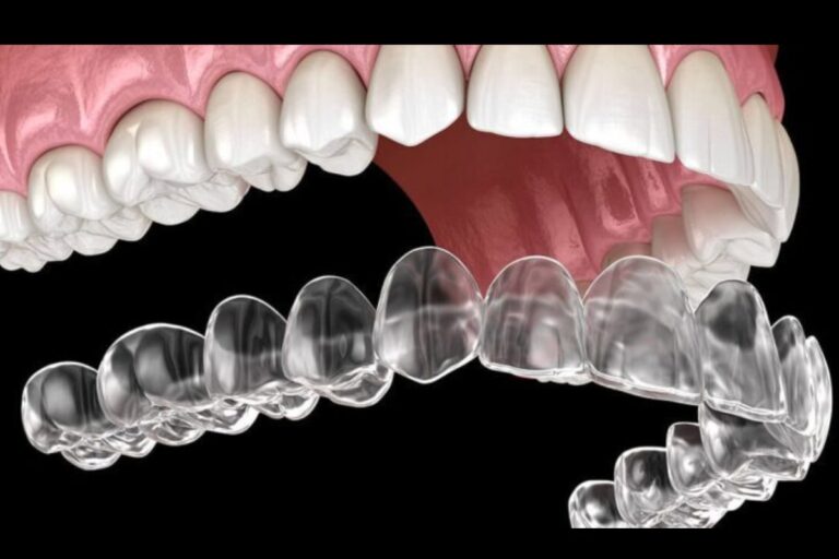 Invisible Aligners: The Simple Solution for Your Crooked Teeth
