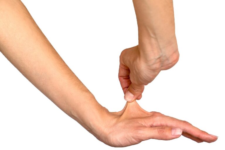 23 Signs You Grew Up with Ehlers-Danlos Syndrome