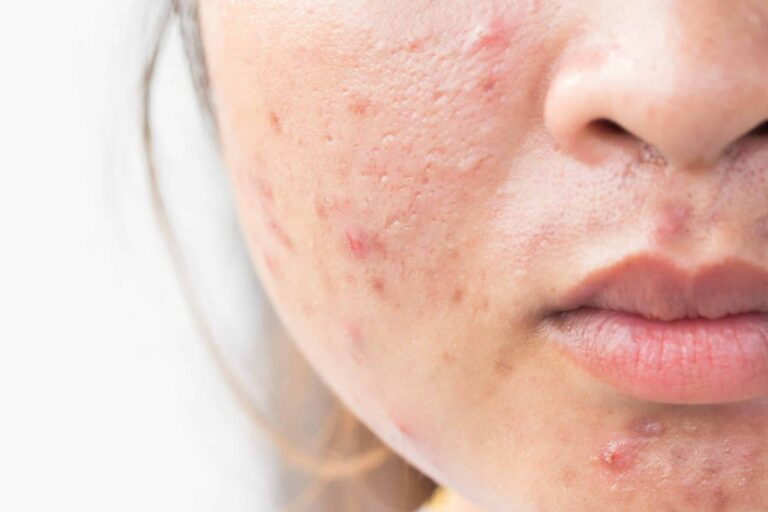 How to Remove Spots from Face in 2 Days Naturally at Home